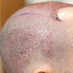 Hair Transplant in Riyadh Profile Picture