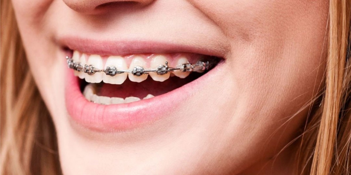 Common Challenges During Dental Braces Treatment