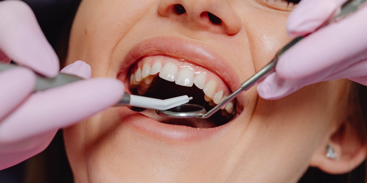 Composite Bonding Near Me | Expert Cosmetic Dentistry at Iconic Smiles